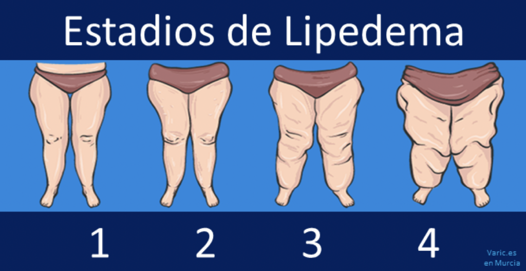 Lipedema - Mediklar Centro Médico Estético